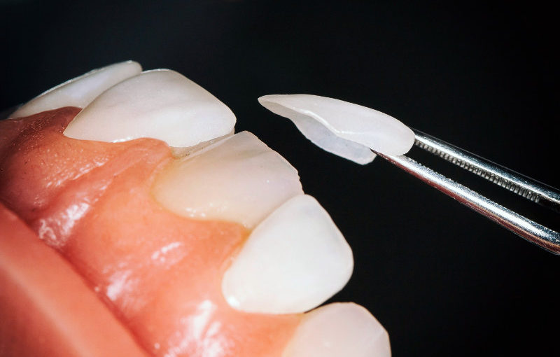 prótesis dental barcelona
