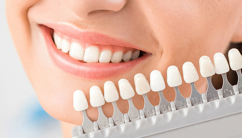 Veneers: Elevating Your Smile with Cutting-Edge Customisation